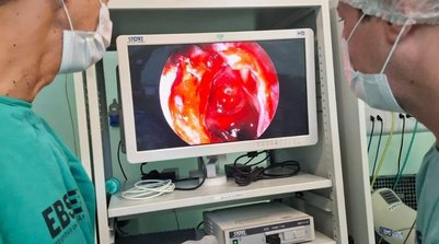 HU-UFPI realiza cirurgia de tumor cerebral com acesso pelo nariz (Foto: Divulgação / UFPI)