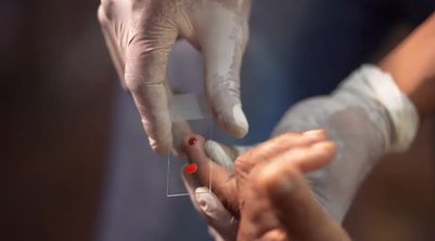 Público infantil concentra cerca de 50% dos casos da doença no país (Foto: TV BRASIL/REPRODUÇÃO)